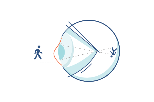Illustrazione di un occhio affetto da astigmatismo