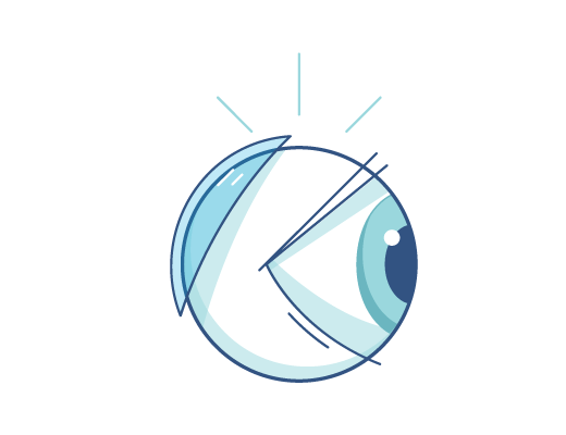 Illustrazione delle lenti a contatto dietro al bulbo oculare